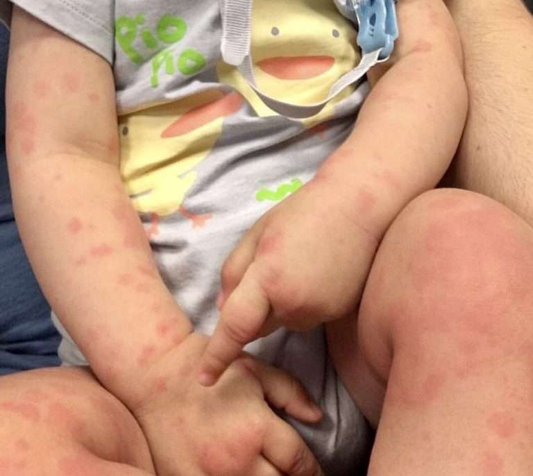 urticaria-hives-child